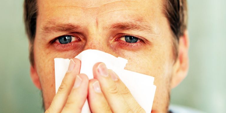 Closeup portrait of red eyed man holding tissue to his nose