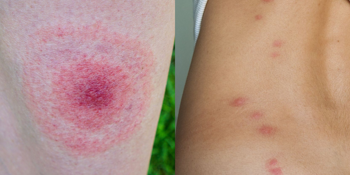 Allergy to bug bites symptoms
