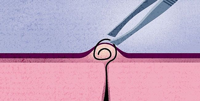 3 Ways To Safely Remove Ingrown Hairs