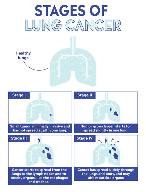 Women in of signs cancer lung Signs Of