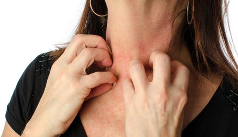 Contact Dermatitis on Neck