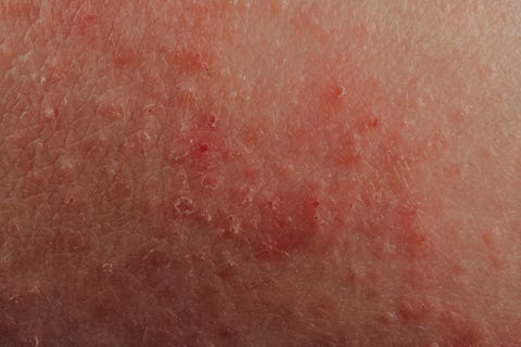 Itchy Skin 14 Causes Pictures And Treatments