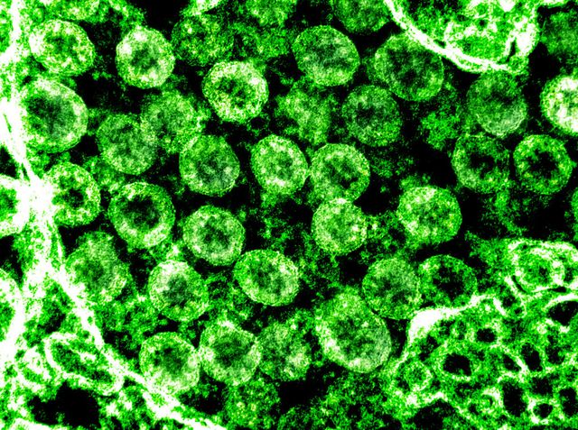 visión de las partículas del coronavirus aisladas en una muestra al microscopio extraída de un paciente