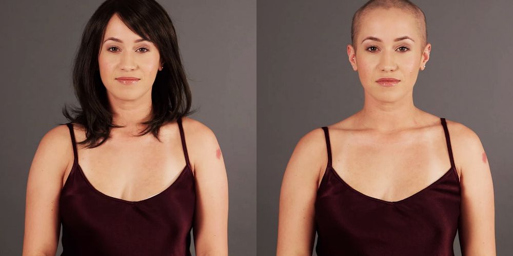 This Woman Started Losing Her Hair After Her Sexual Assault 