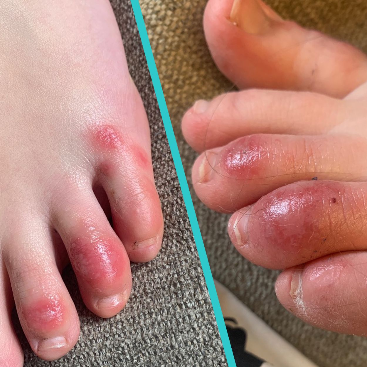broken skin under toes