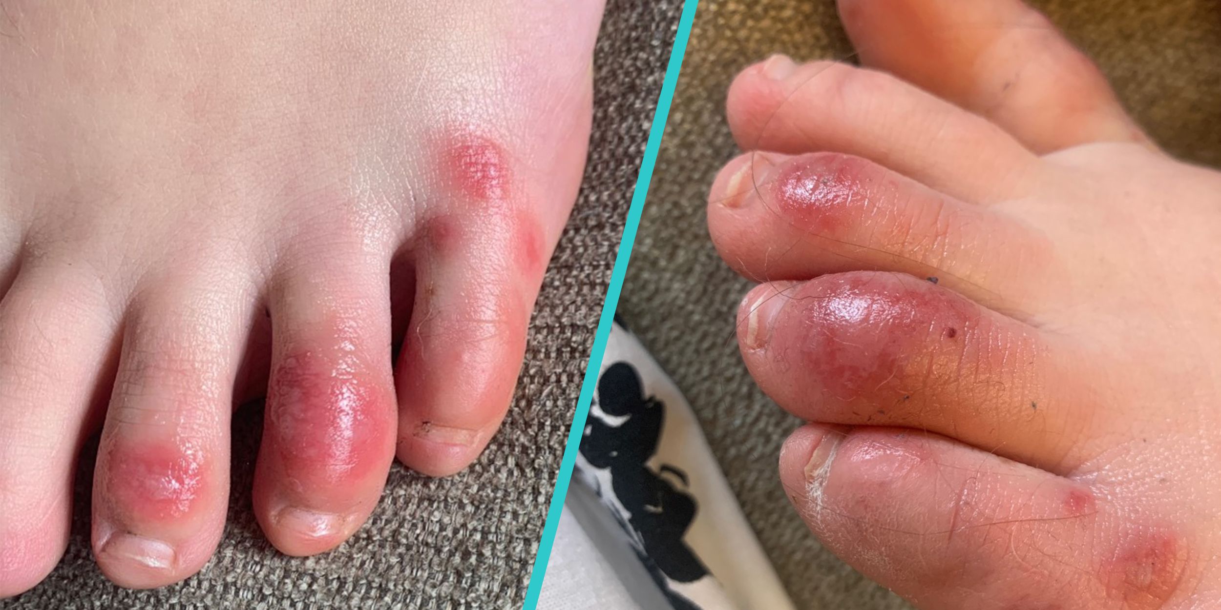 sore cracks between toes