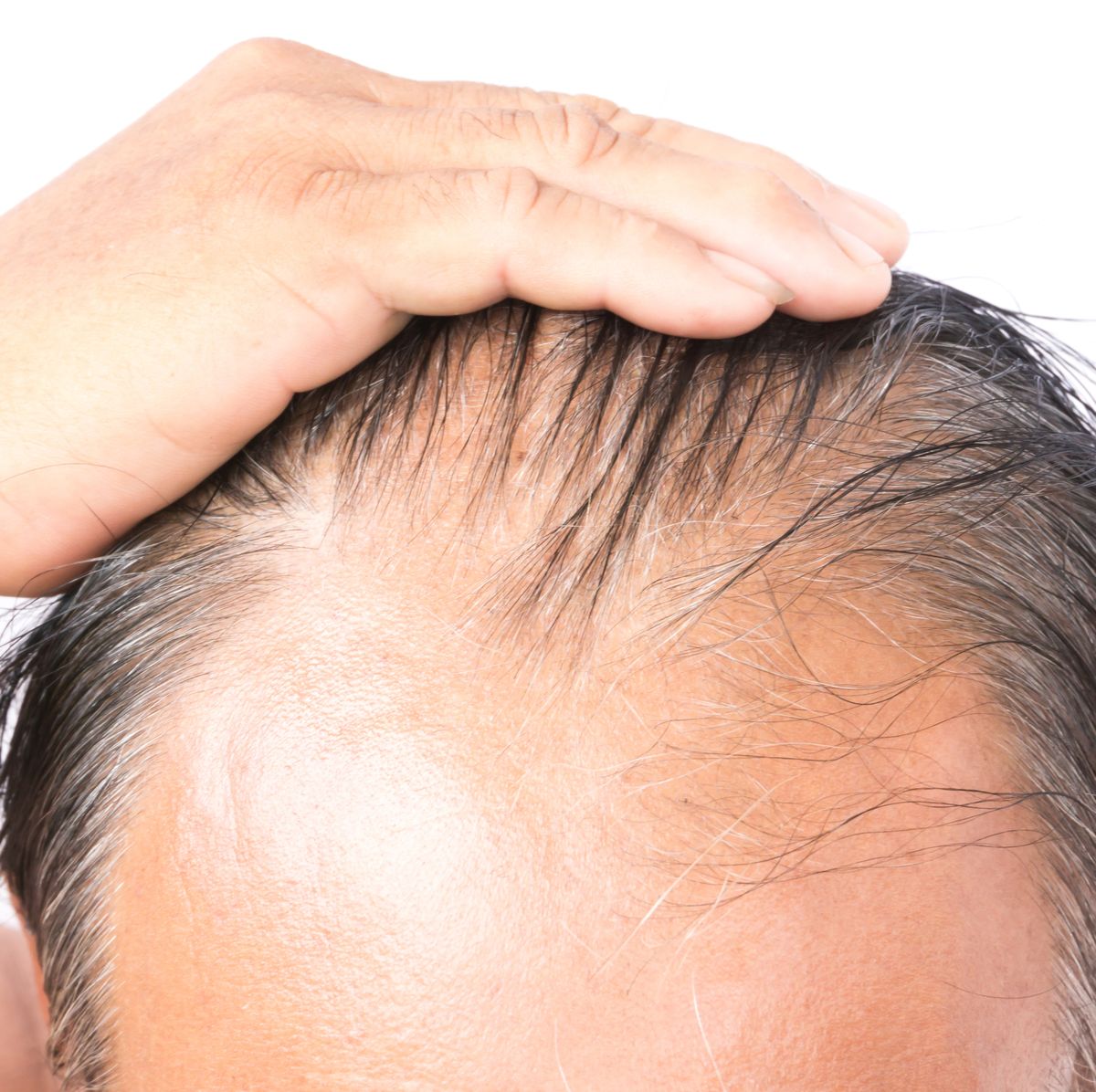 10 things you should know about hair thinning in men