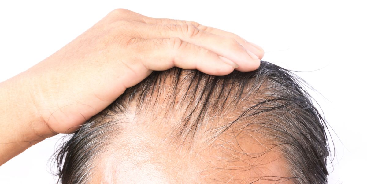 10 Things You Should Know About Male Hair Loss