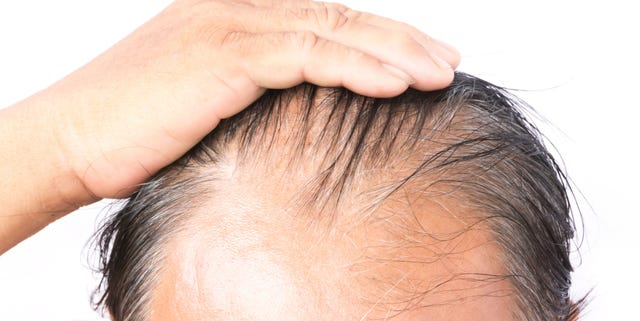 Male Hair Loss