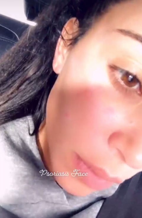 Kim Kardashian S Psoriasis Is Visible On Her Face In New No Makeup Instagram Video Kim Kardashian S Psoriasis Is Visible On Her Face In New No Makeup Instagram Video