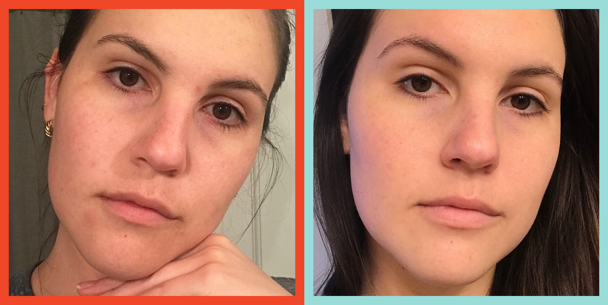 Curology Review I Tried Curology For 60 Days To Treat My Acne 2020 3498