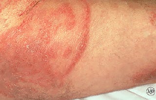 13 Common Causes For Itchy Butt Rashes And Bumps According To Mds