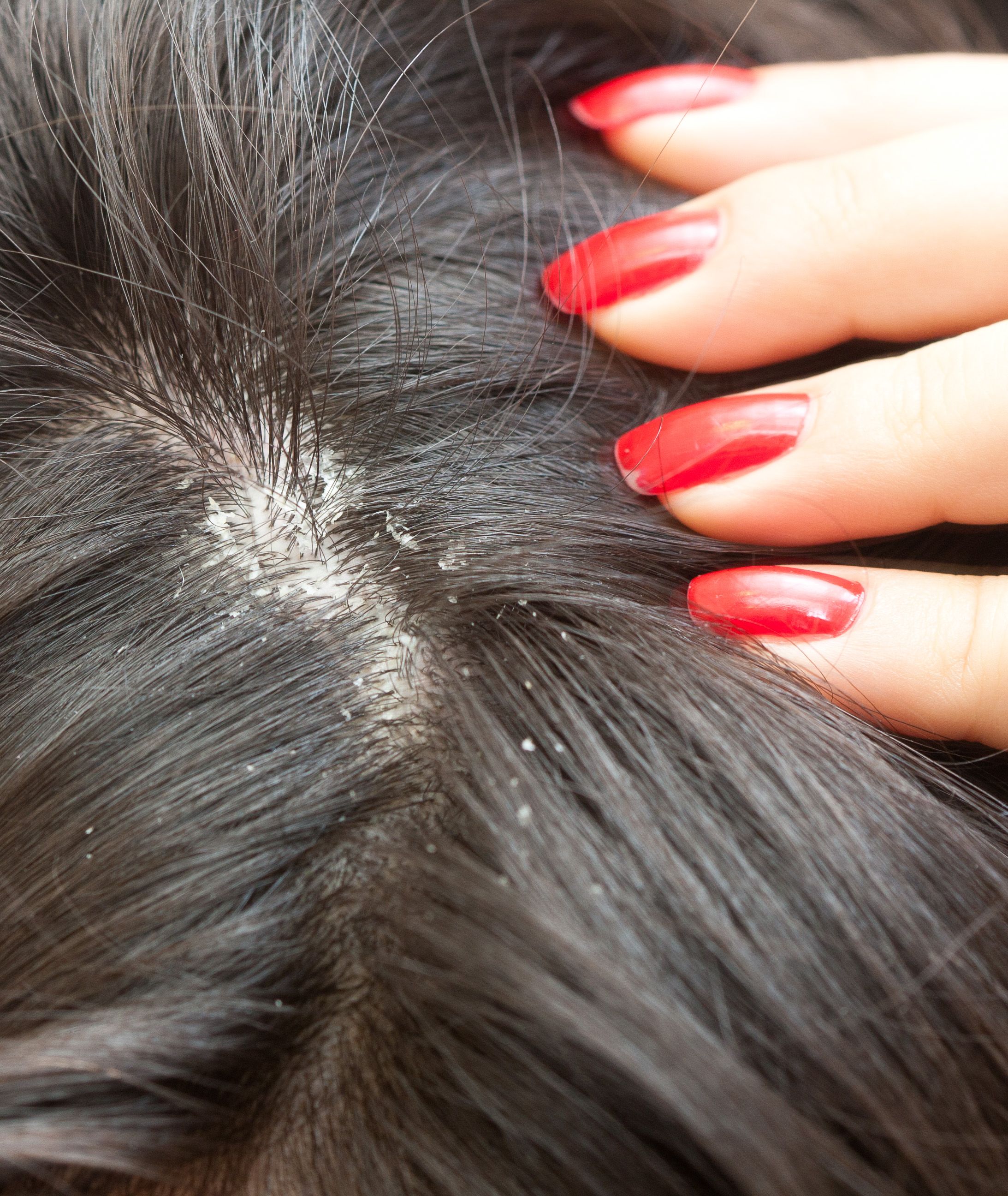 Lice vs Dandruff - How to Tell Difference Between Lice & Dandruff