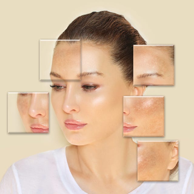 Melasma