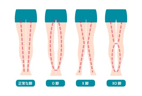 治らない は嘘 O脚の原因 治し方をトレーナーにask