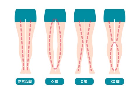 治らない は嘘 O脚の原因 治し方をトレーナーにask