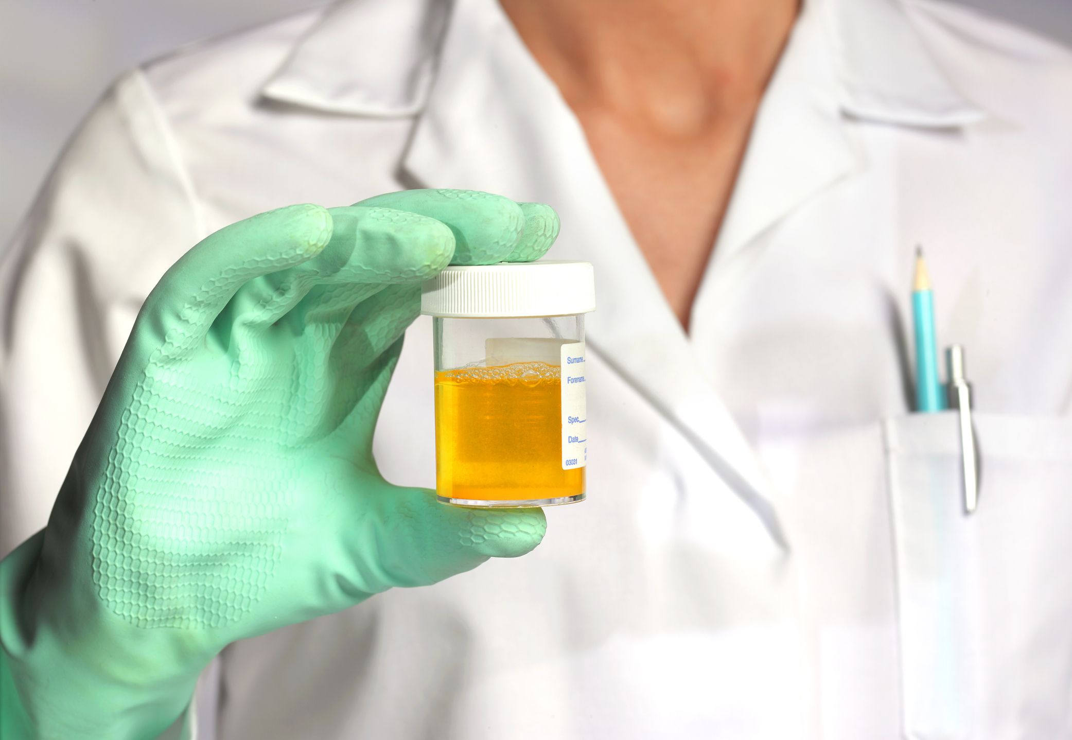White blood cells in urine: what it means