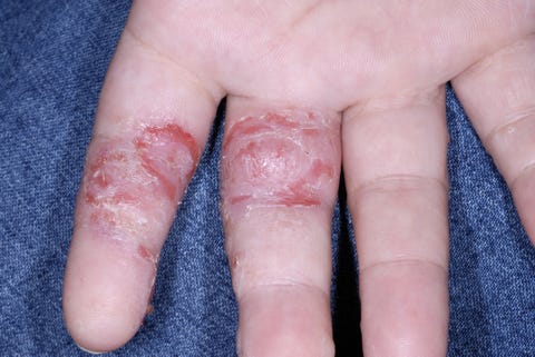 Dyshidrotic eczema