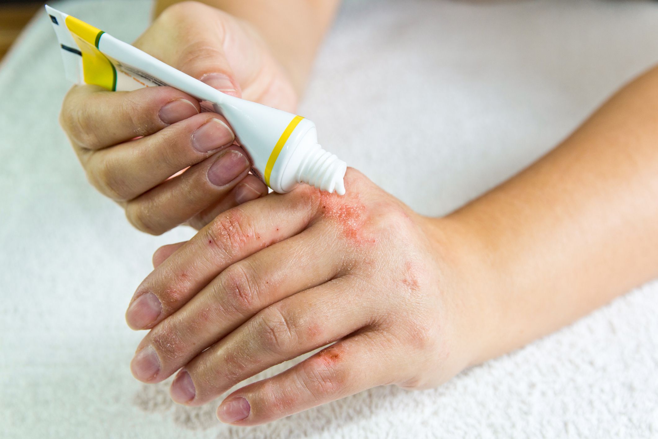 dermatitis on top of hands