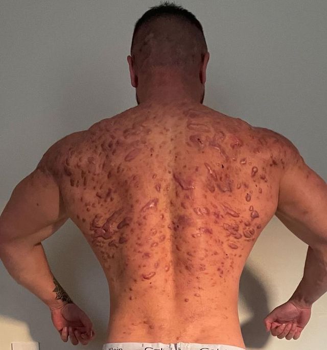el culturista dave hartrey muestra las cicatrices que le han causado los esteroides