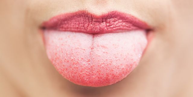 inflammation of tongue papillae papilom pe negi pubiene