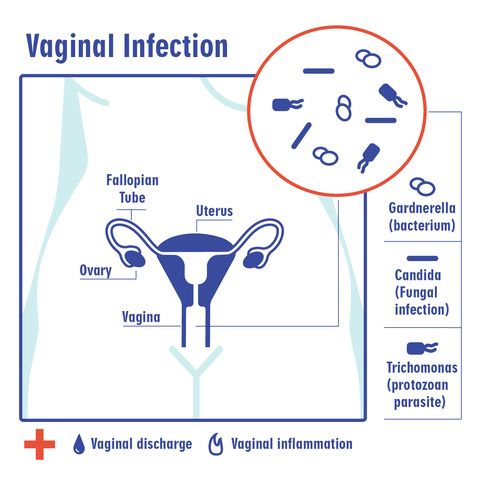 Vaginal Yeast Infection Symptoms, Causes, Treatment, Prevention
