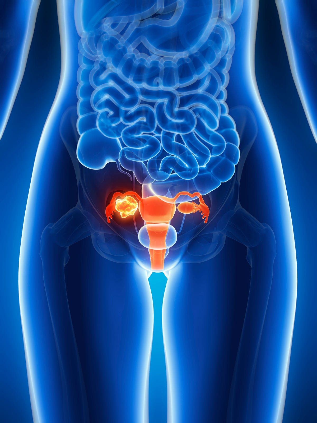 ovarian-cancer-diagnosis-why-early-detection-is-so-difficult