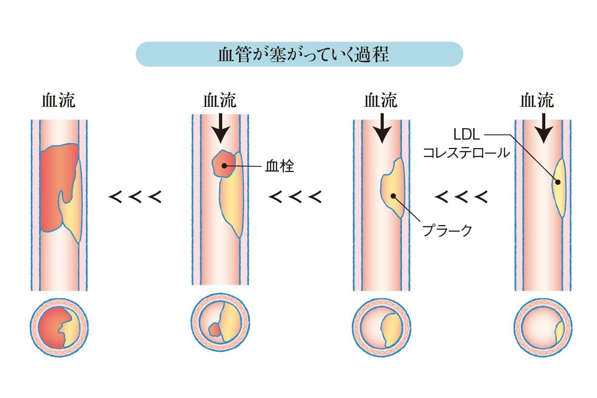 閉経すると動脈硬化になりやすいって本当 更年期のお悩み相談室