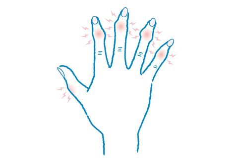 関節の痛み 手のこわばり 更年期特有の手指の悩みに答えます