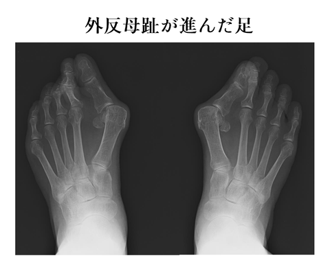 外反母趾 巻き爪 靴擦れ タコ いまこそ 足トラブルに終止符を 外反母趾 巻き爪 靴擦れ タコ いまこそ 足トラブルに終止符を