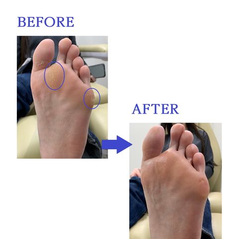 外反母趾 巻き爪 靴擦れ タコ 足トラブルの治療法やセルフケア方法を紹介