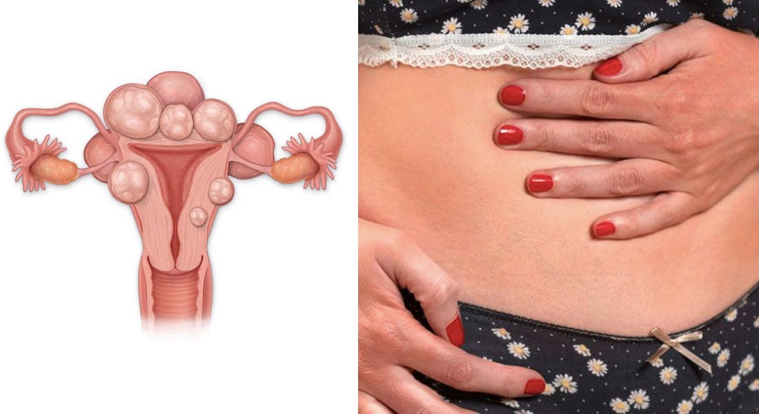 What Are Fibroids Symptoms Of Fibroids And Fibroid Treatmen