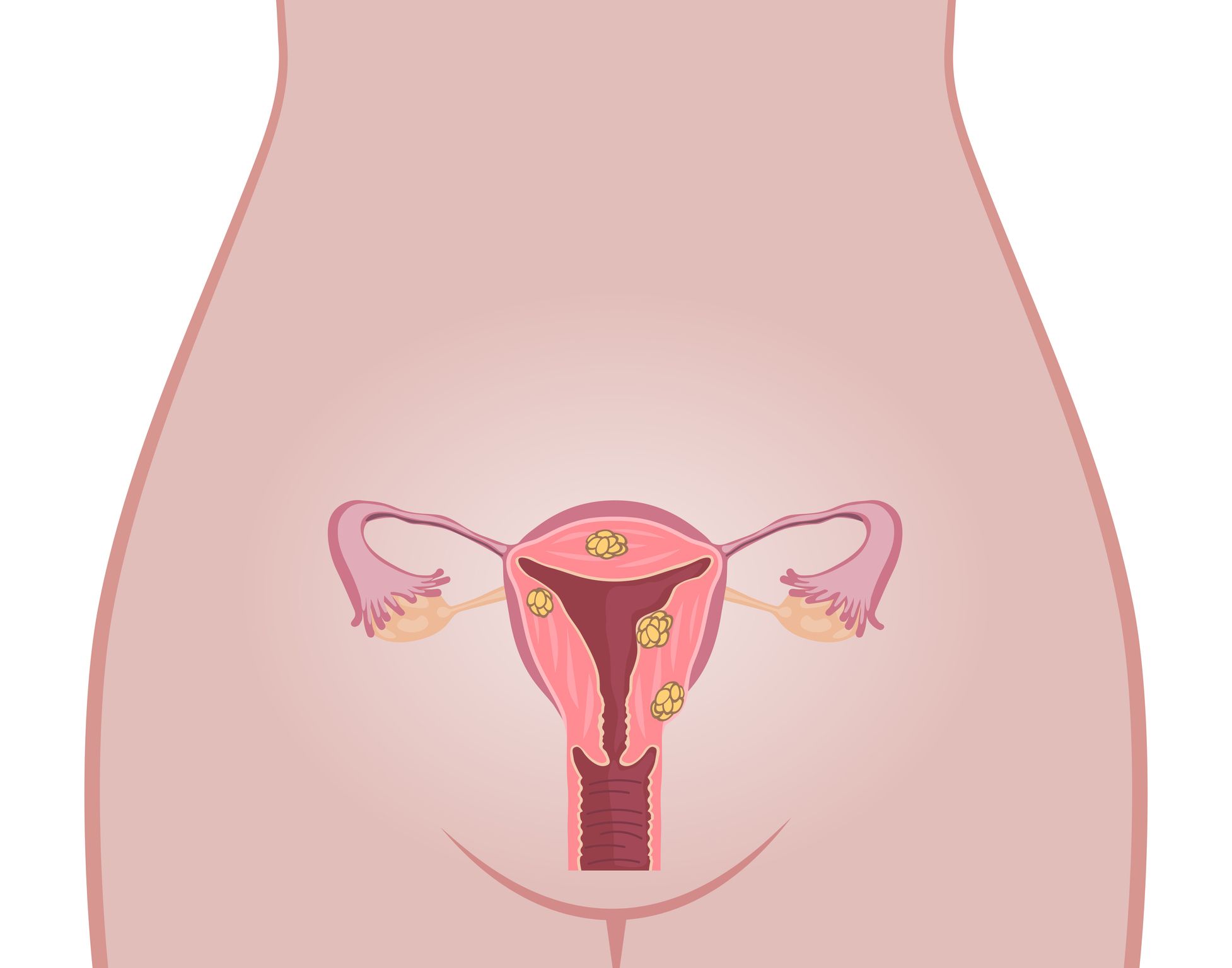 Fibroids Everything You Need To Know