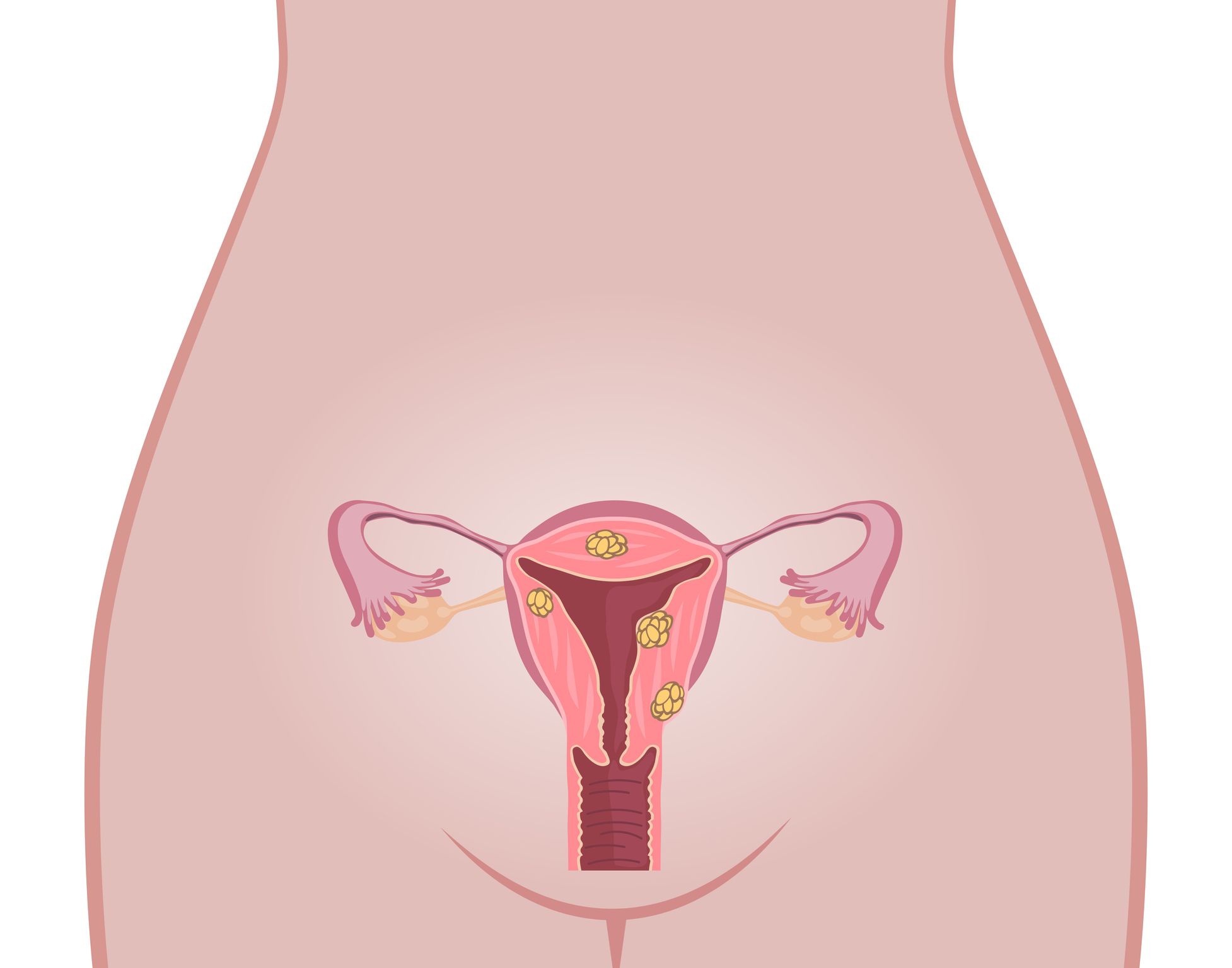 Fibroids: causes, symptoms, diagnosis, treatment