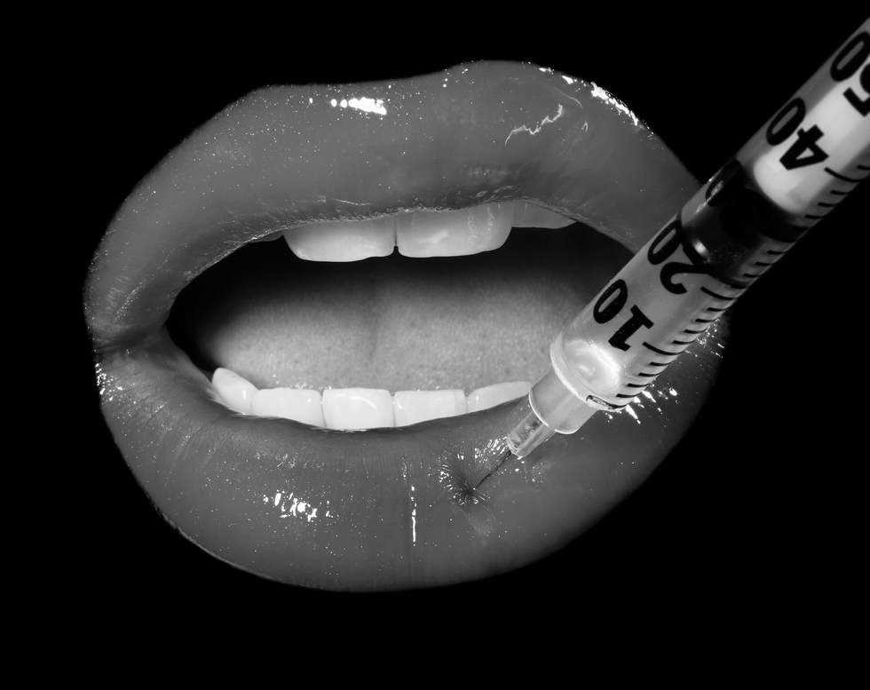 Filler Migration Is Real—Here's What You Can Do About It