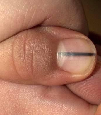 Woman shares picture of the mark on her fingernail that turned out to be a  sign