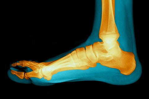 Flat Foot
