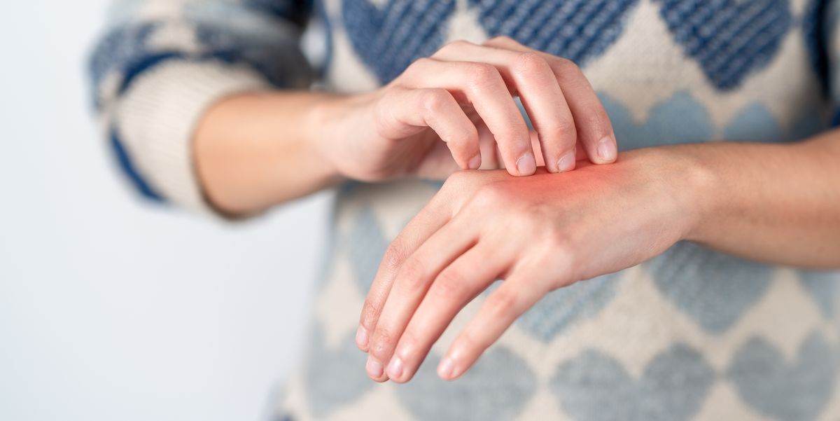 Flea bite: symptoms, treatment and prevention