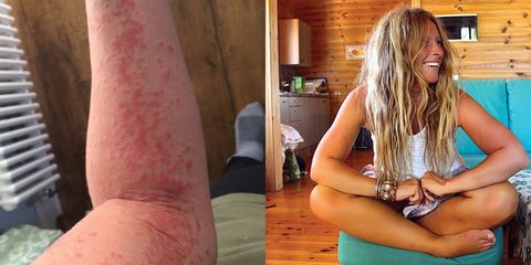 Hanna Sillitoe psoriasis pictures