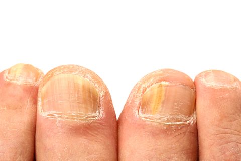 8 Reasons Your Nails Are Yellow According To Dermatologists