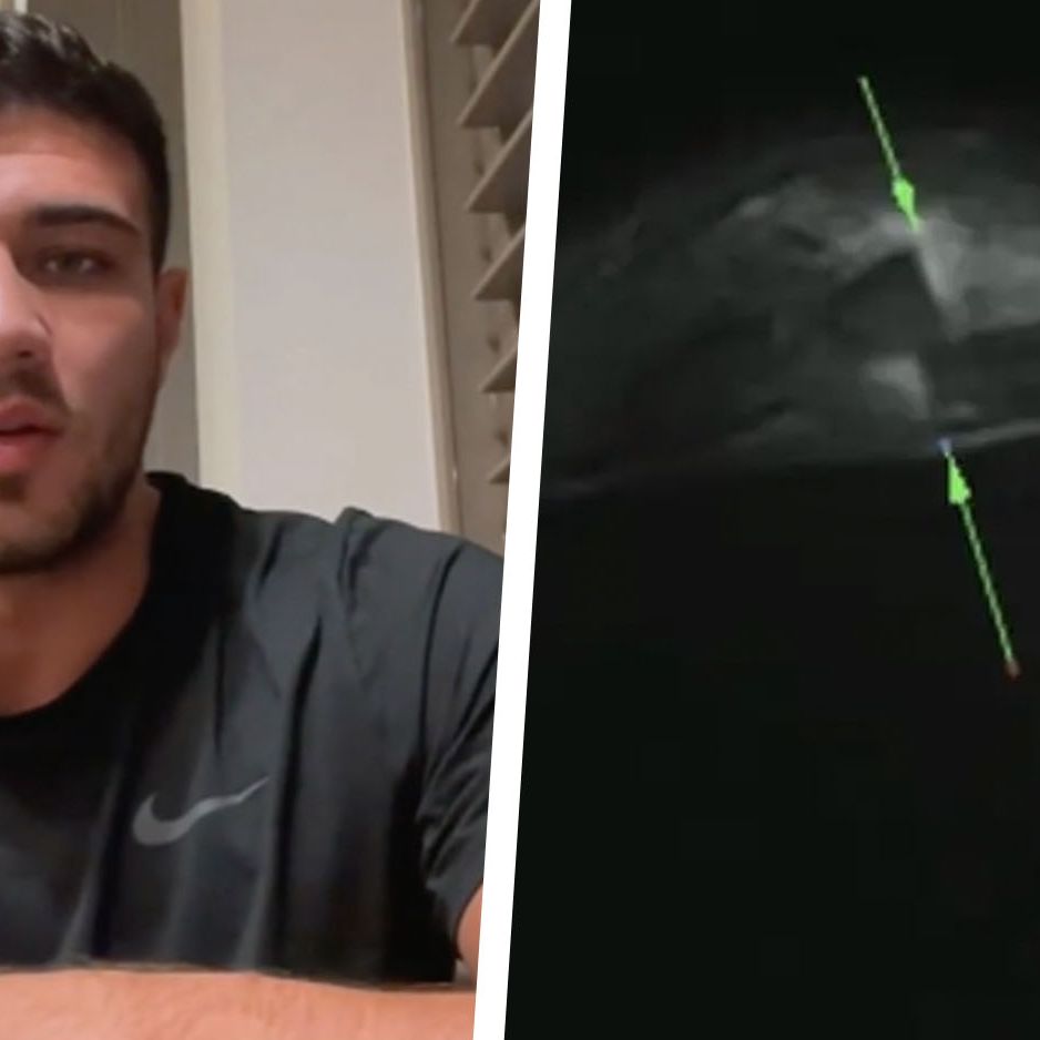 Tommy Fury Shared Hospital X-Rays to Prove His Withdrawal from the Jake Paul Fight Was Genuine
