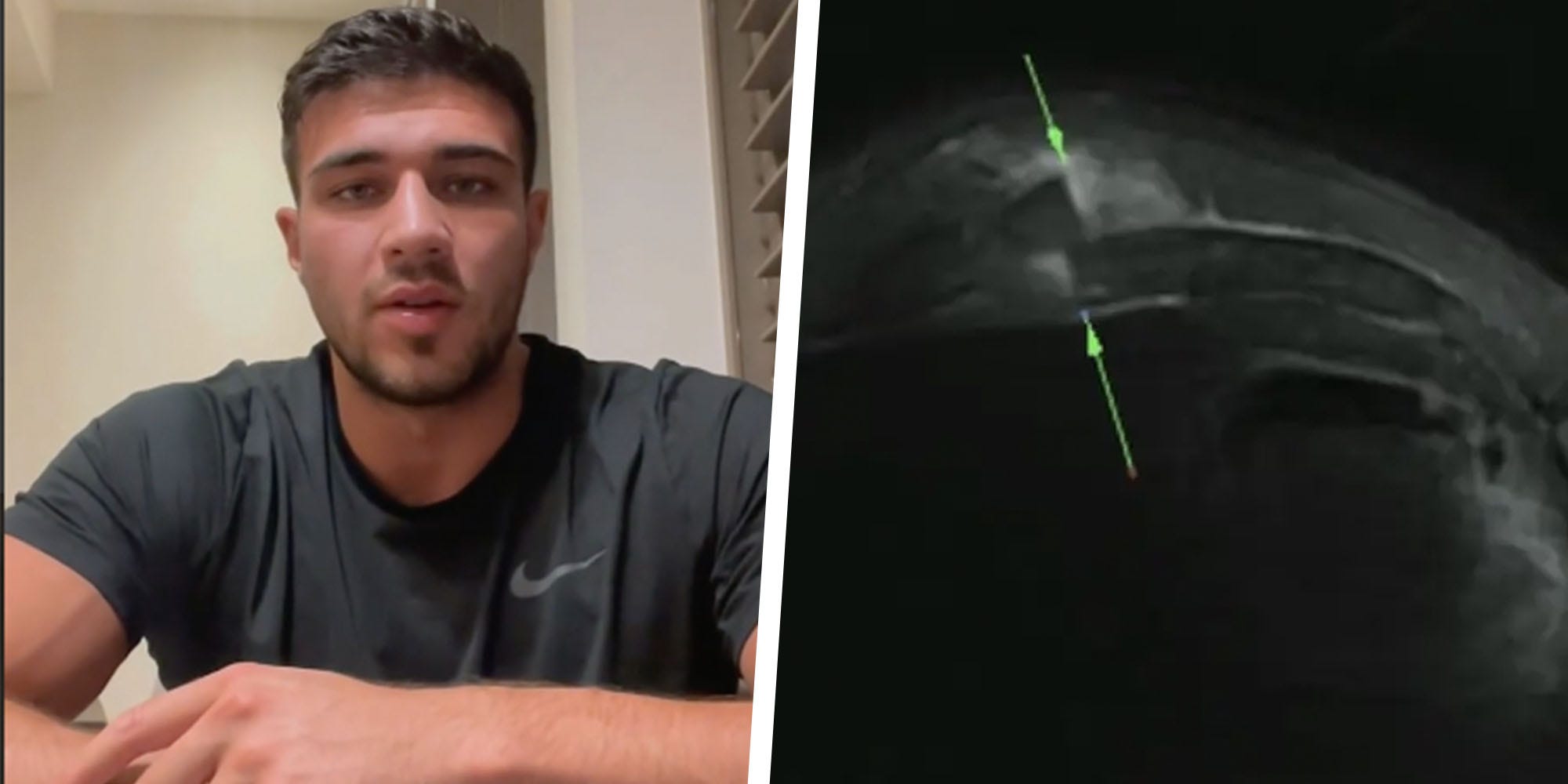 Tommy Fury Shared Hospital X-Rays to Prove His Withdrawal from the Jake Paul Fight Was Genuine