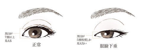 まぶたが下がる 眼瞼下垂 がんけんかすい ってなんですか まぶたが下がる 眼瞼下垂 がんけんかすい ってなんですか
