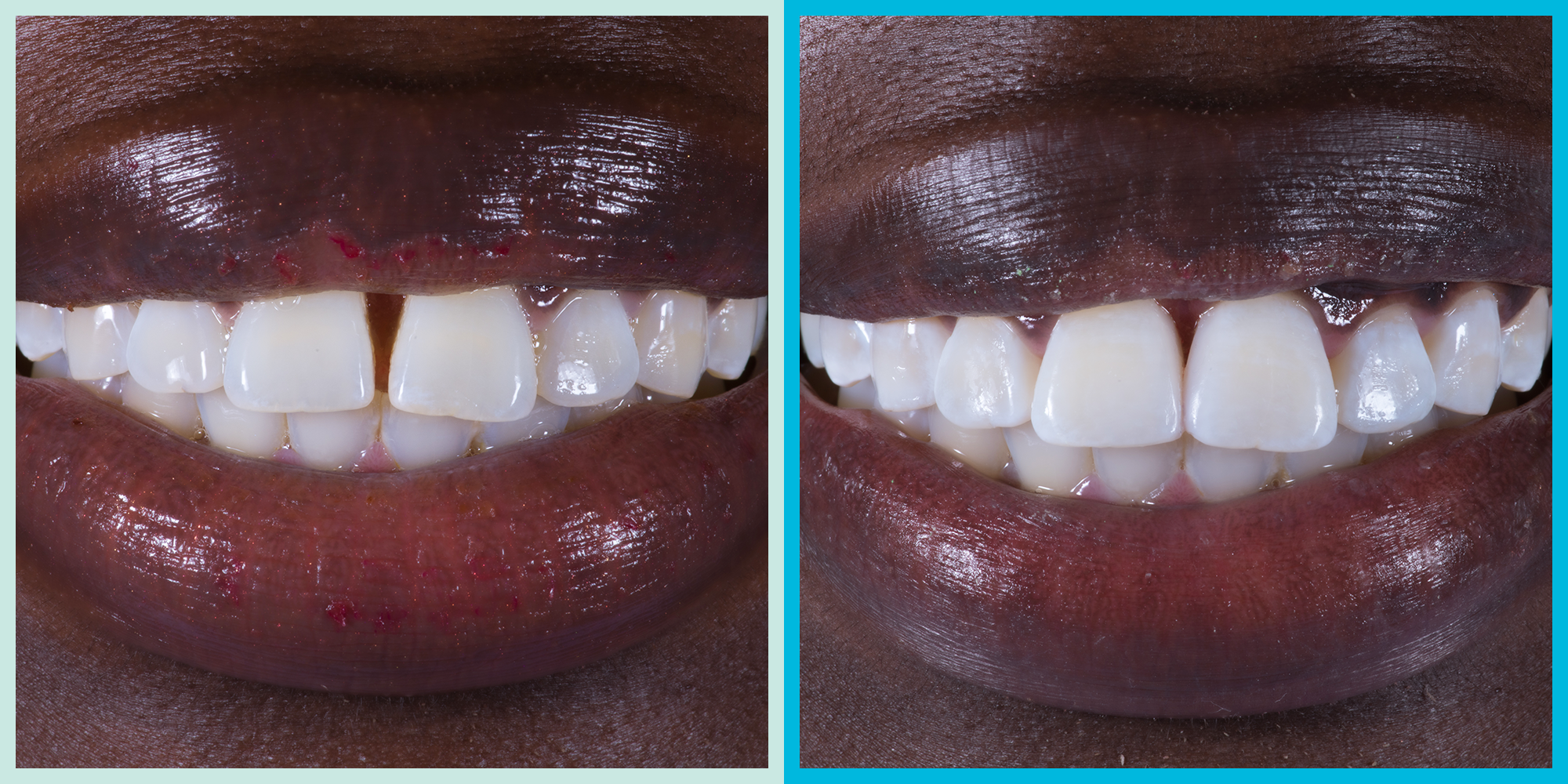How I Closed The Gap In My Teeth With Biomimetic Dentistry