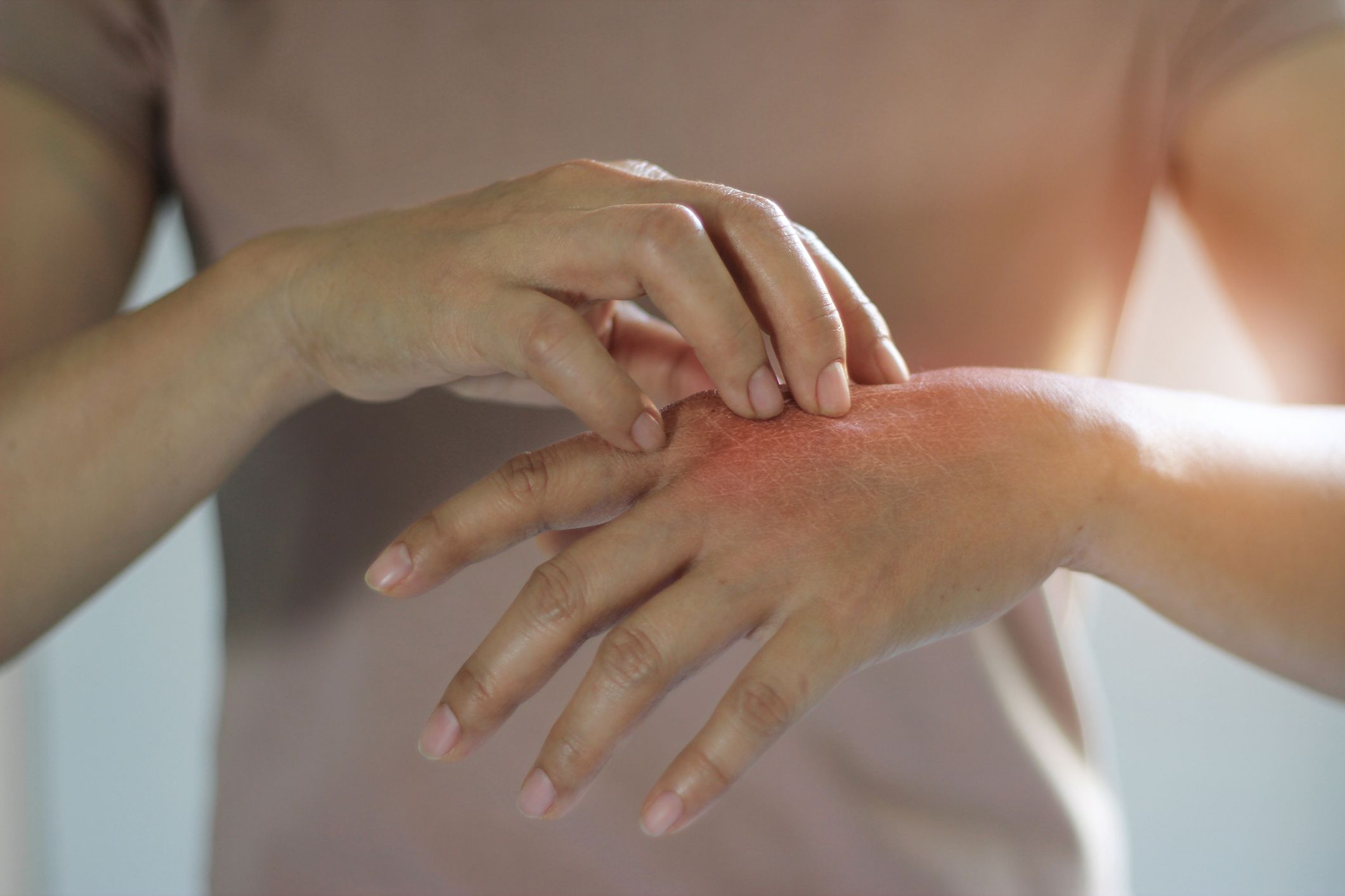 Dry Hands Peeling Skin Image & Photo (Free Trial) | Bigstock
