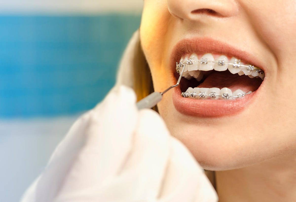 ‘I got a brace in my 40s and this is what I learned’