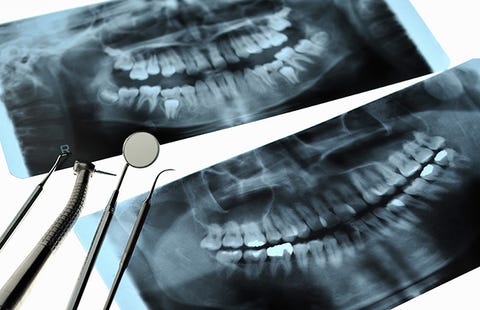 dental x-rays on film