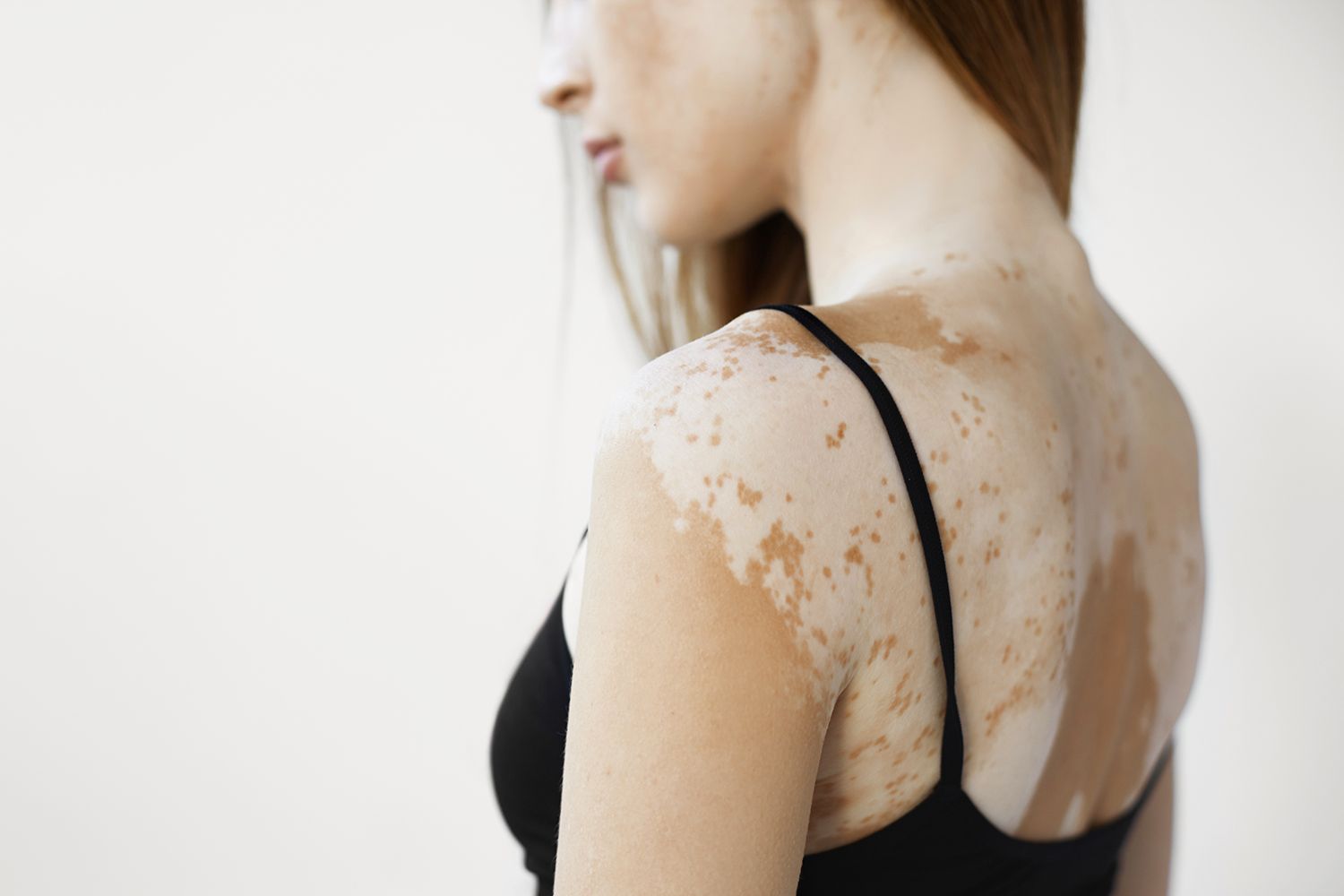 cropped back view of beautiful young european woman with skin condition that causes loss of melanin posing indoors slender slim female model in black tank top suffering from vitiligo disorder