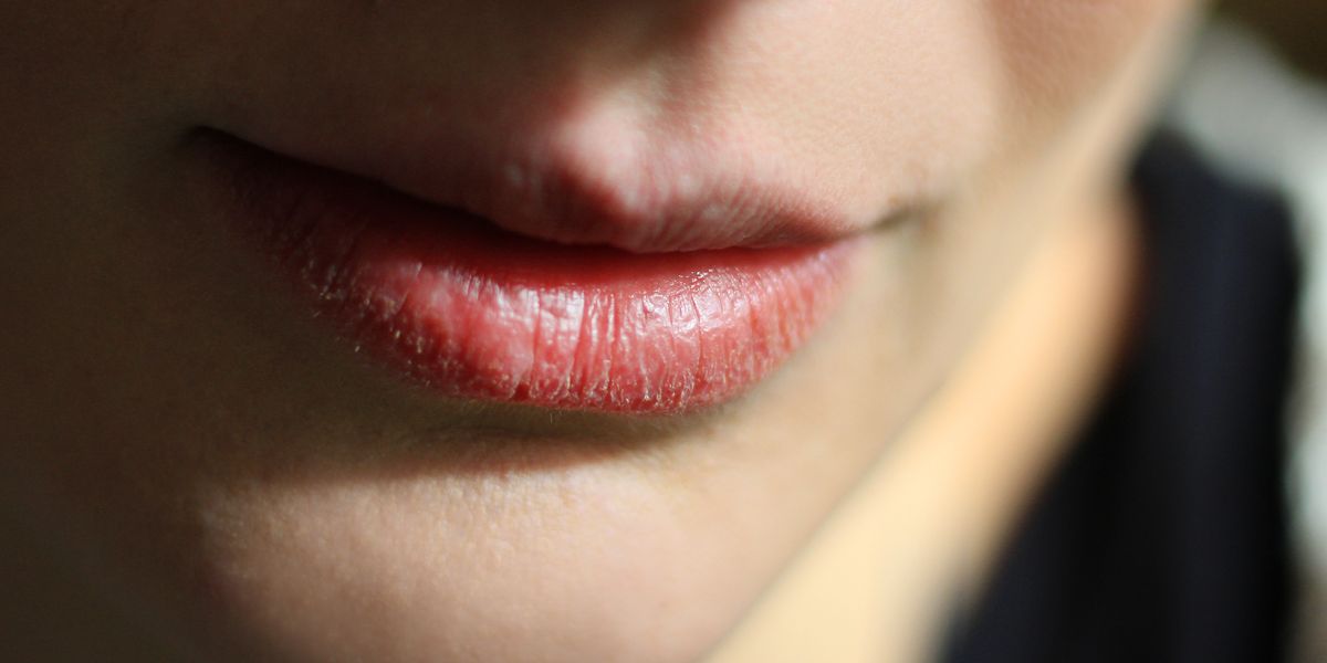 12 Reasons You Have Chapped Lips And How To Treat Them