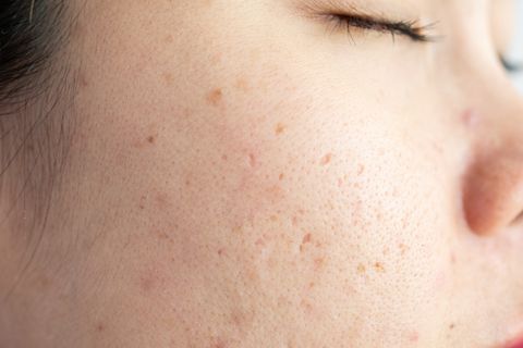 problems with acne and scar on the female skin